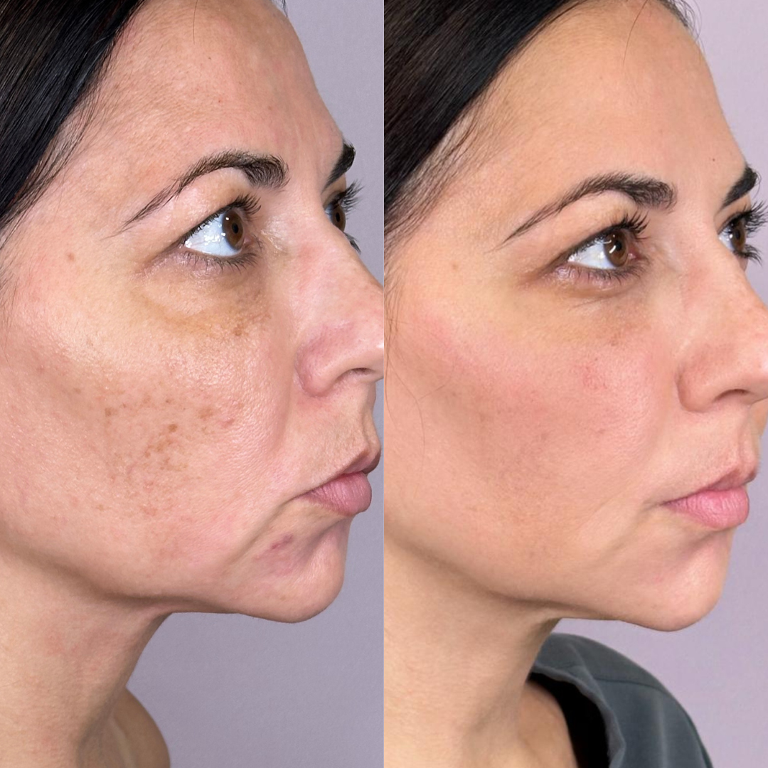 Treatment Results from Sciton BBL
