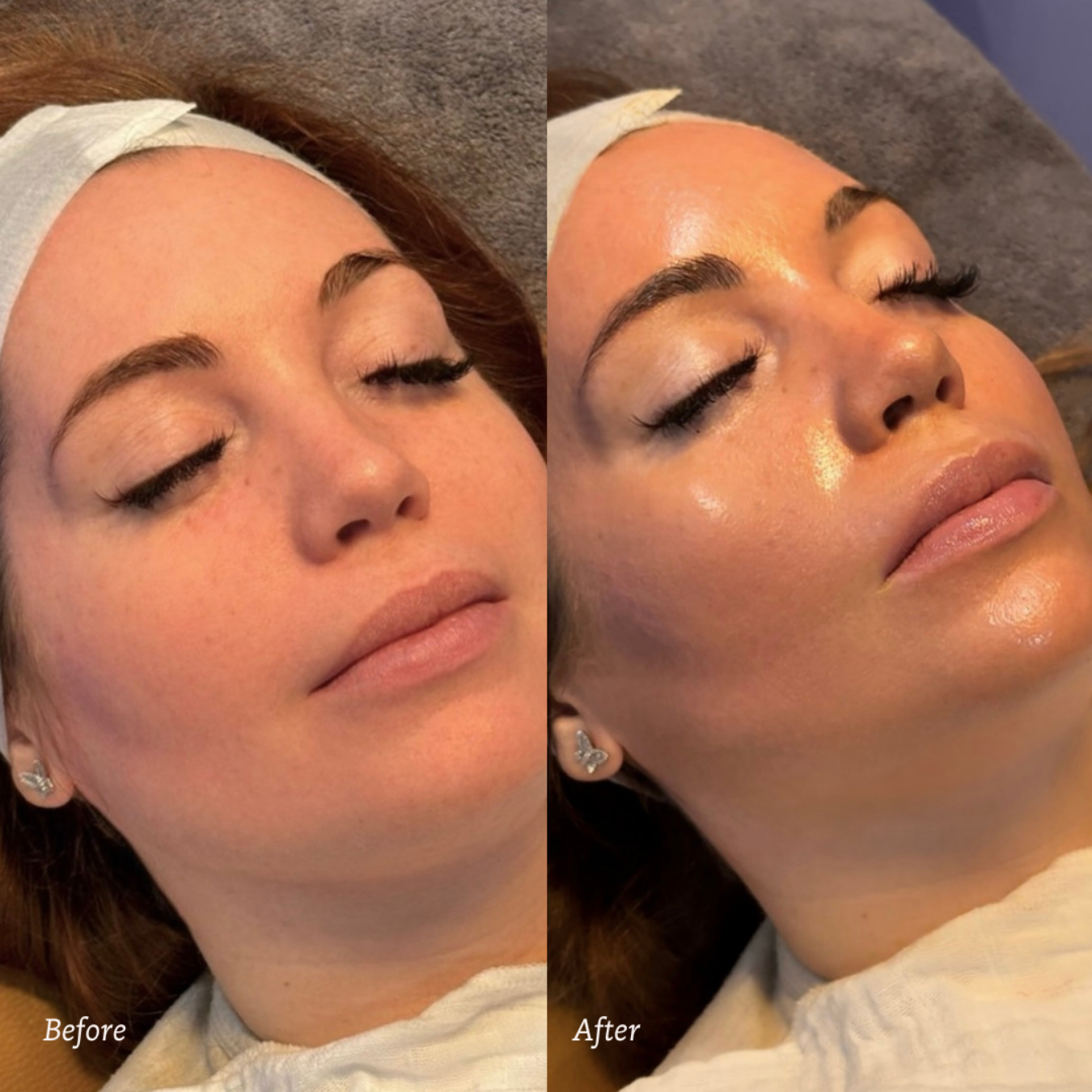 Results From Hydrafacial Deluxe