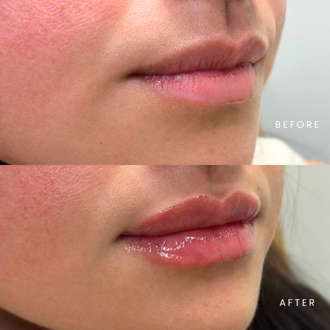 Results From Dermal Fillers