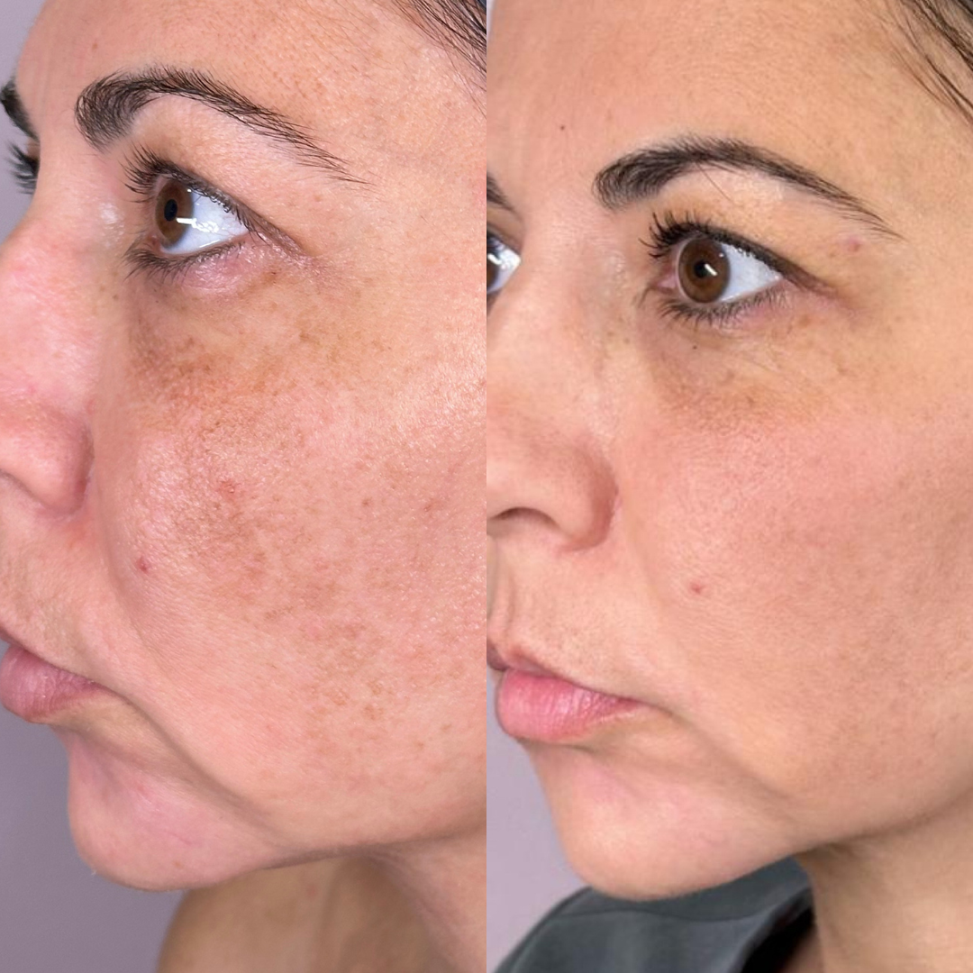 Treatment Results from Sciton BBL