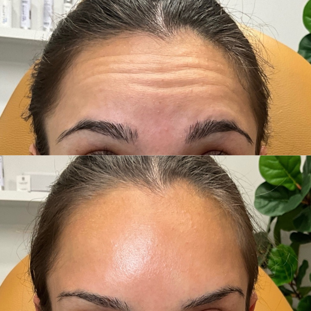 Results from Botox Treatment
