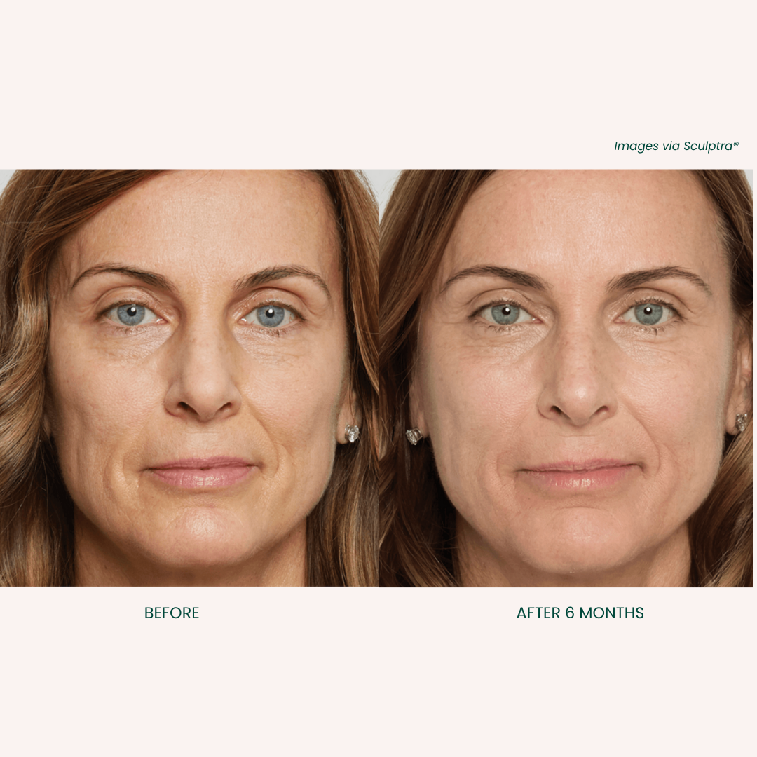 Sculptra Treatment Results 