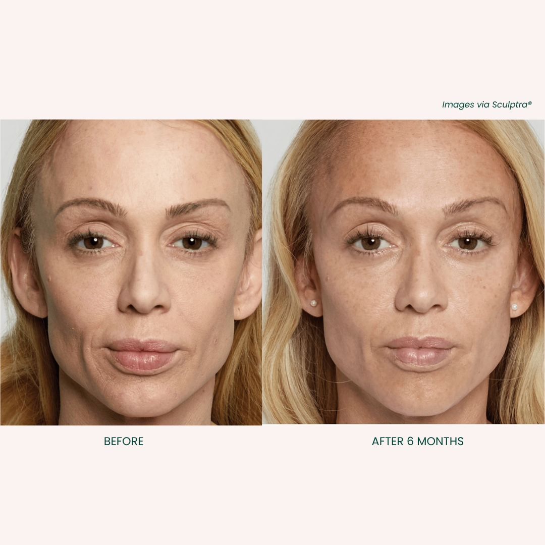 Sculptra Treatment Results 