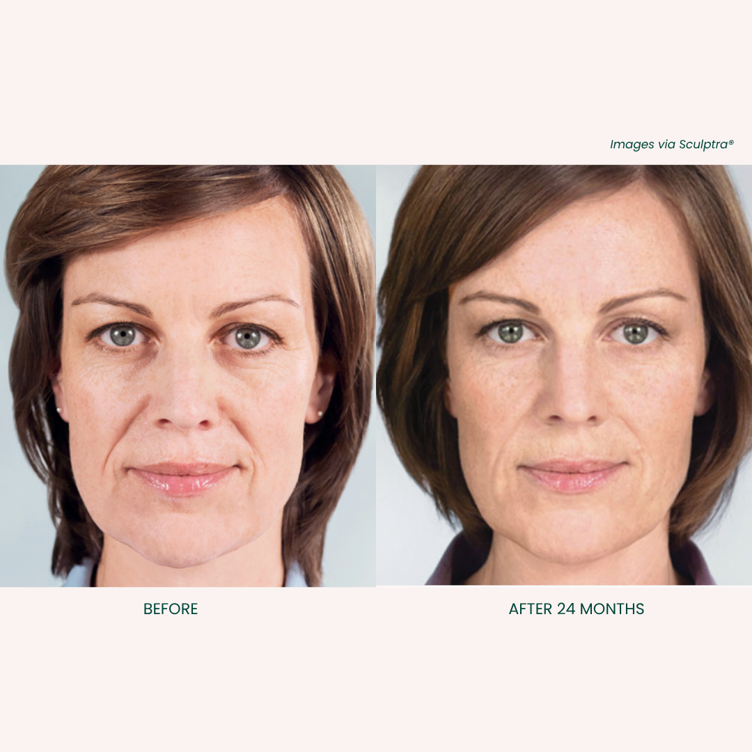 Sculptra Treatment Results 