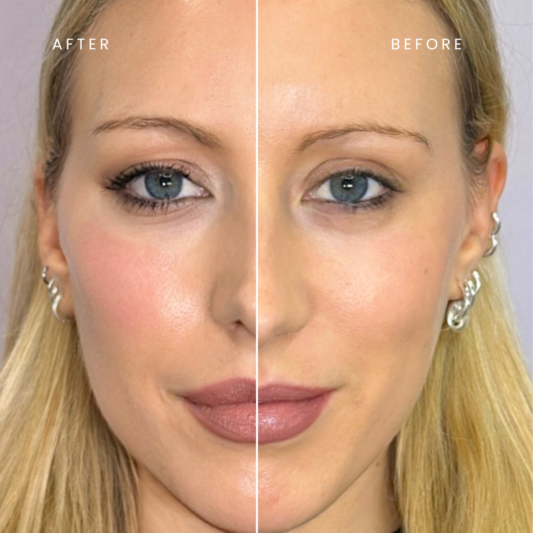 Results From Dermal Fillers