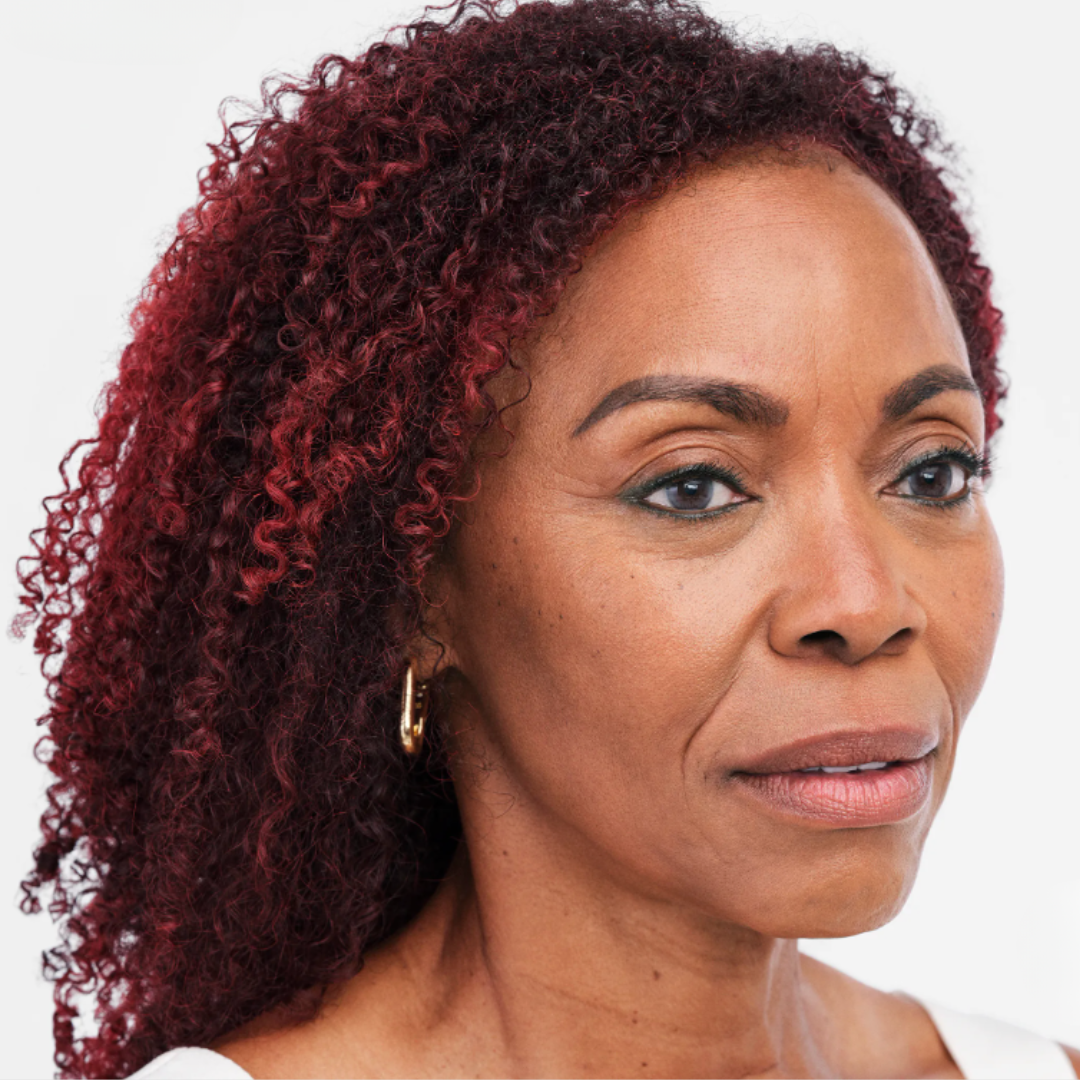 Before Radiesse Treatment