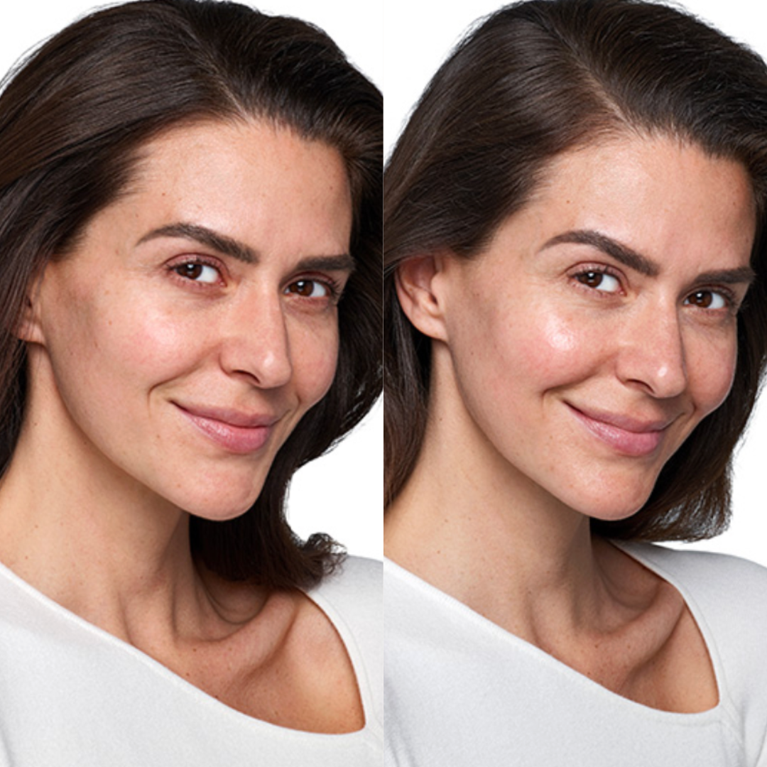 Results from Skinvive® Treatment