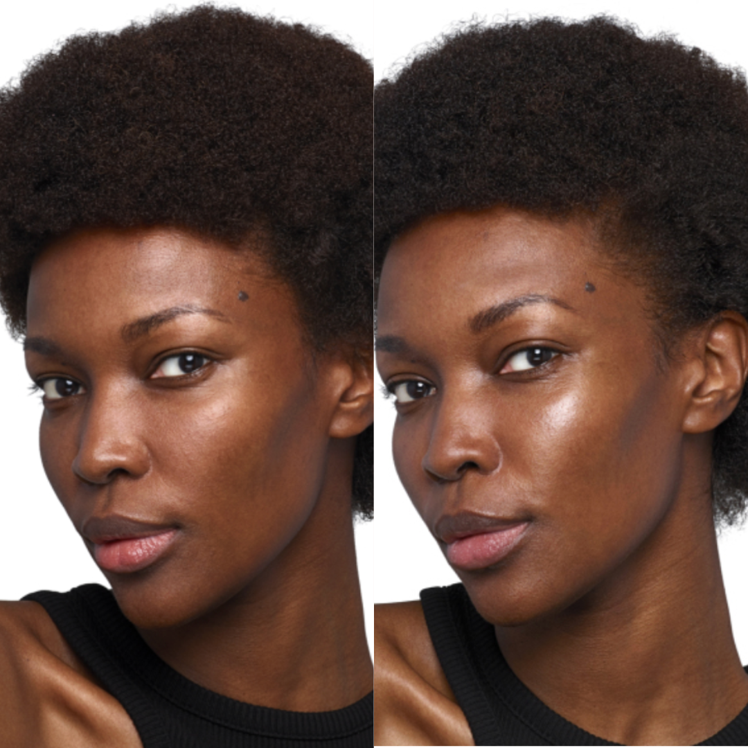 Results from Skinvive® Treatment