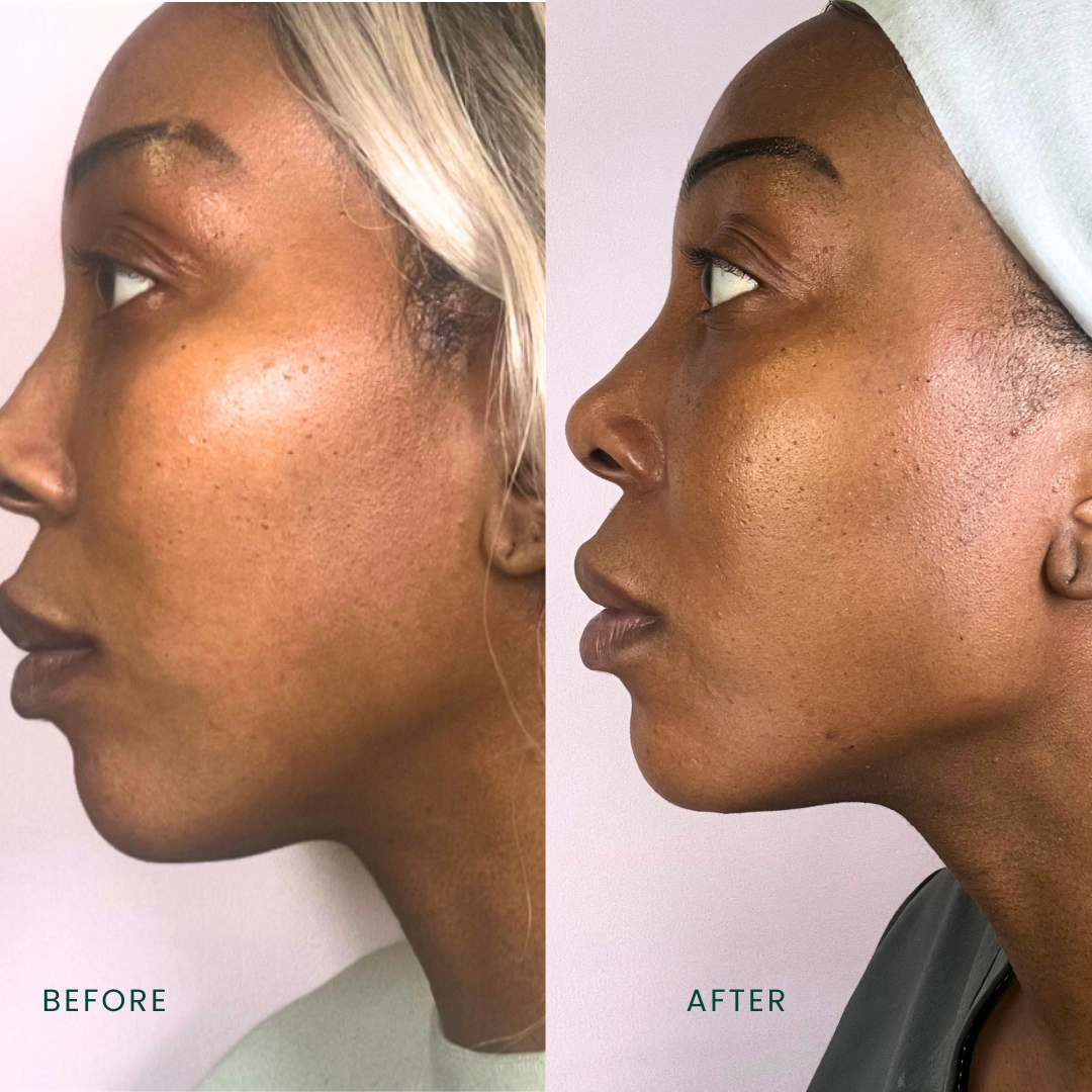 Results From Dermal Fillers