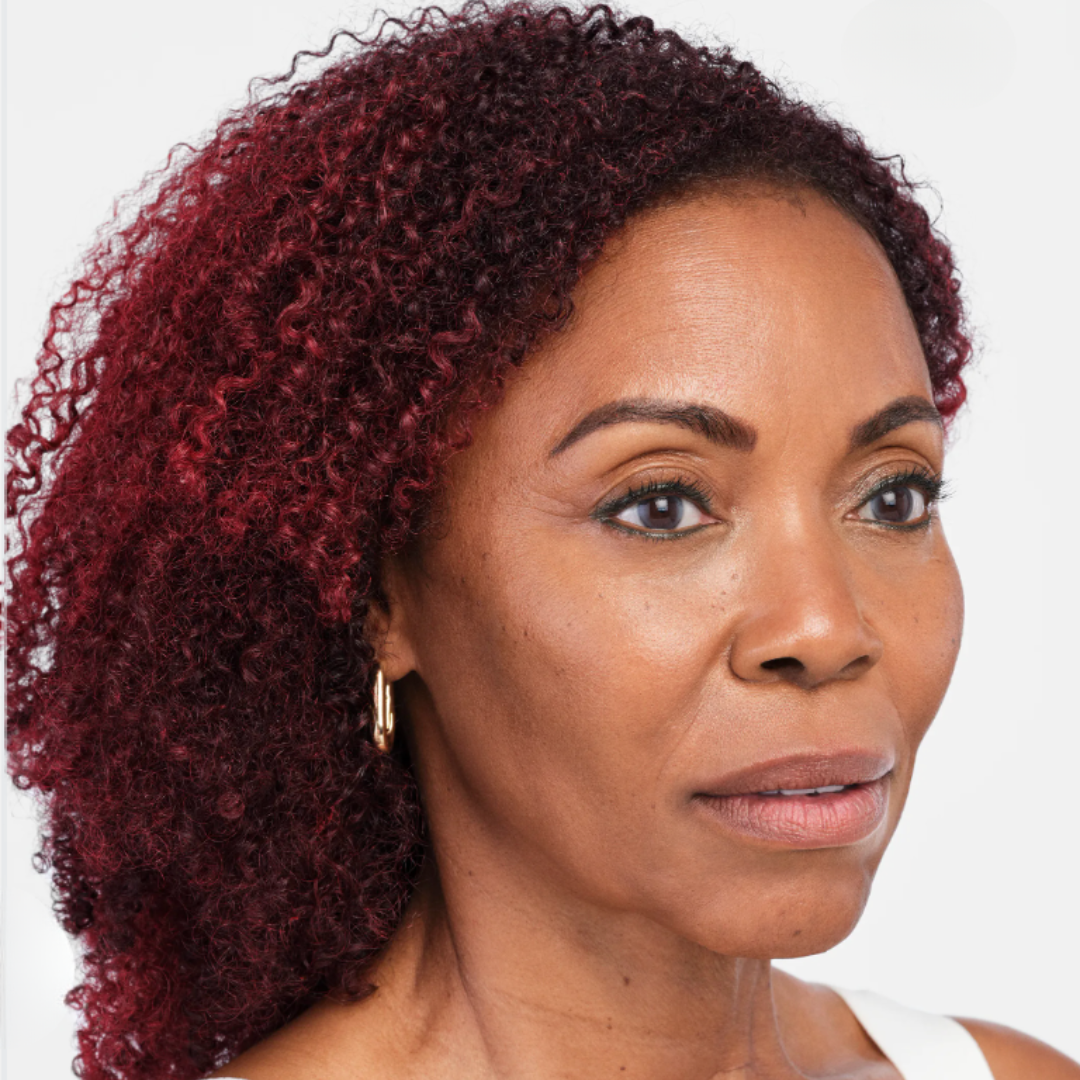 After Radiesse Treatment