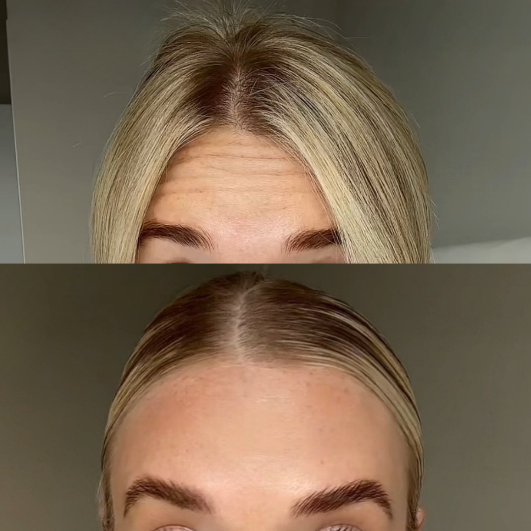 Results from Botox Treatment