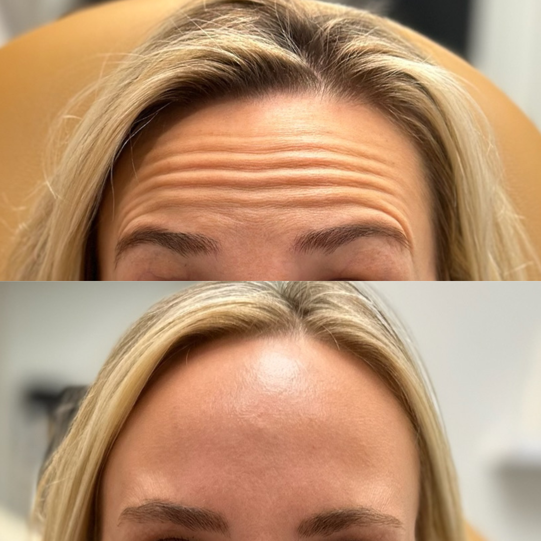 Results from Dysport Treatment