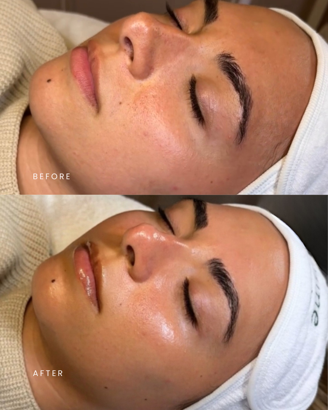 Results From Attune Hydrafacial