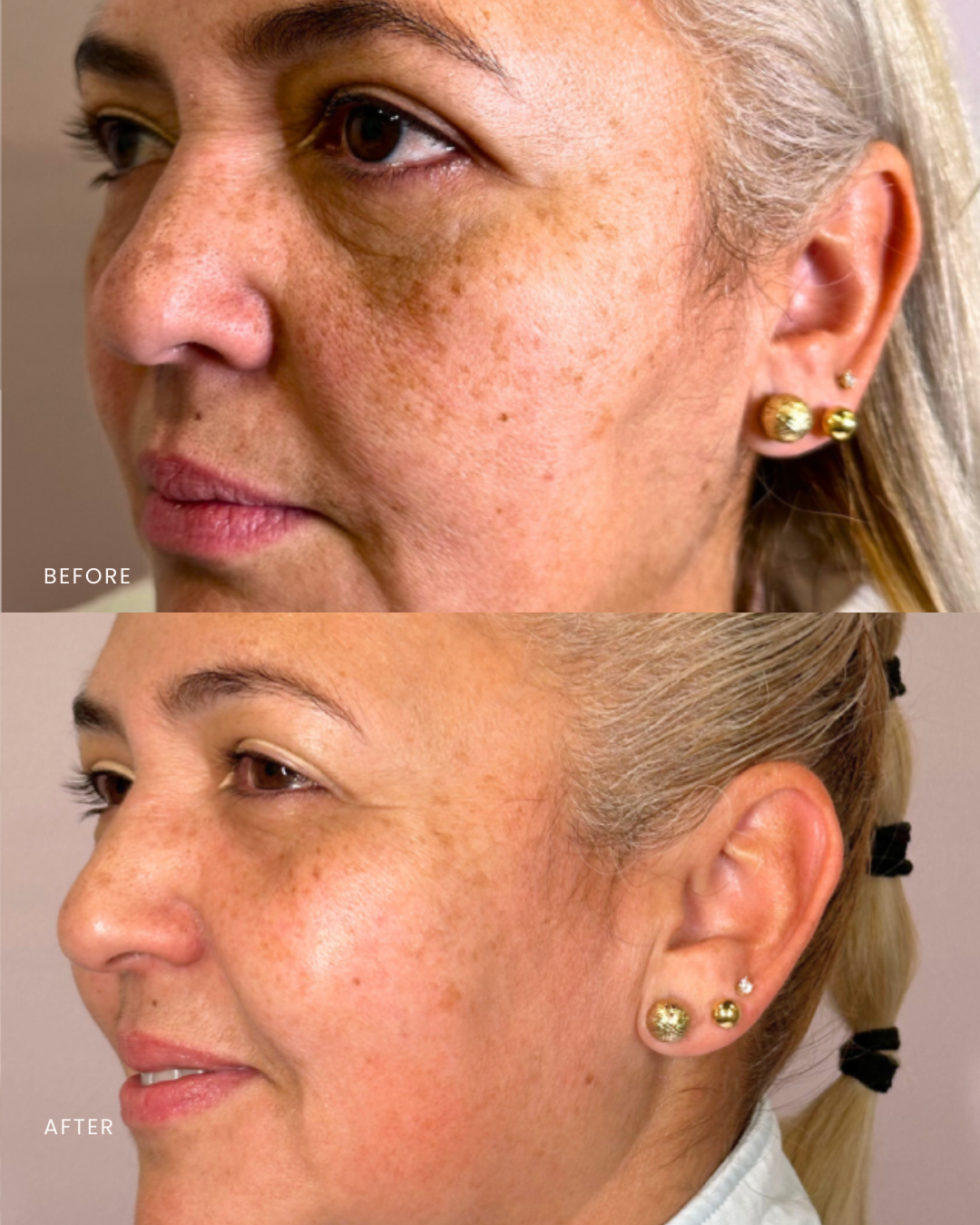 Results from Skinpen® Microneedling